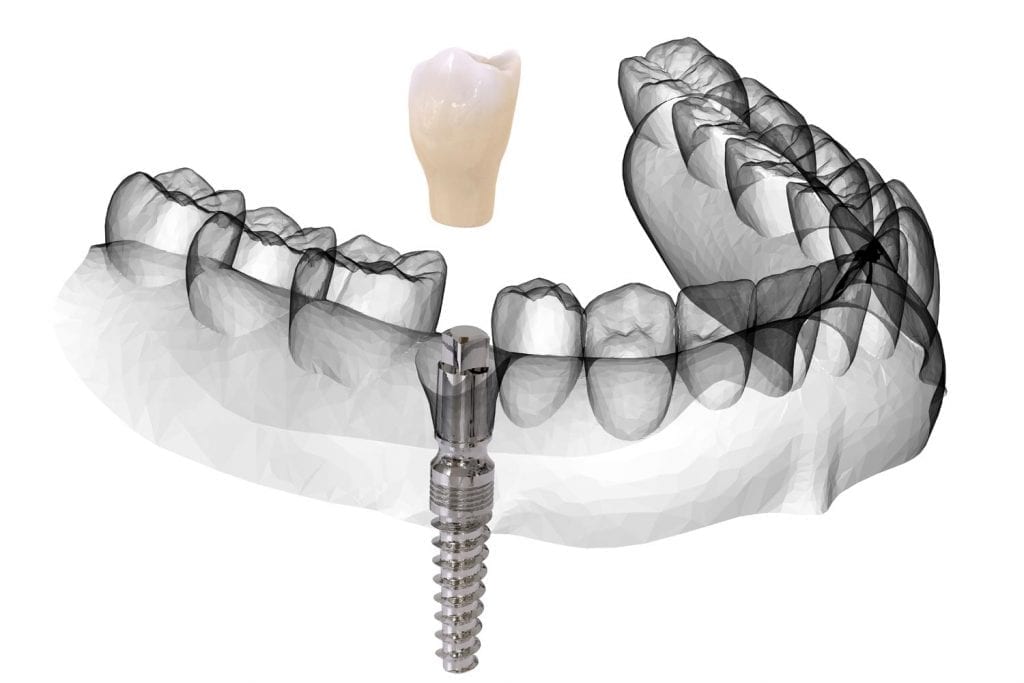 Dental Implants